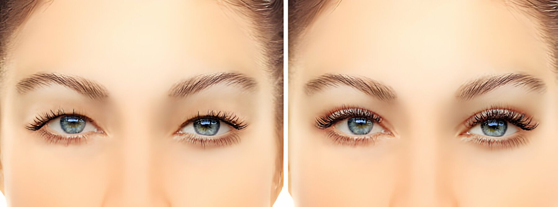 Eyelid lift Surgery