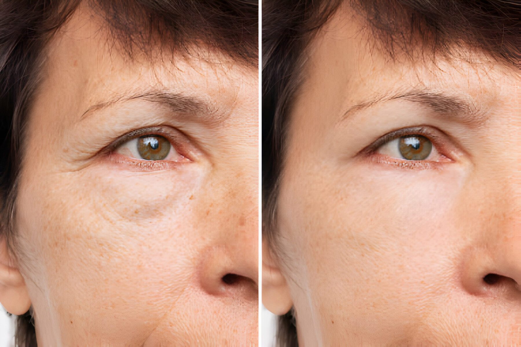 Eyelied surgery
