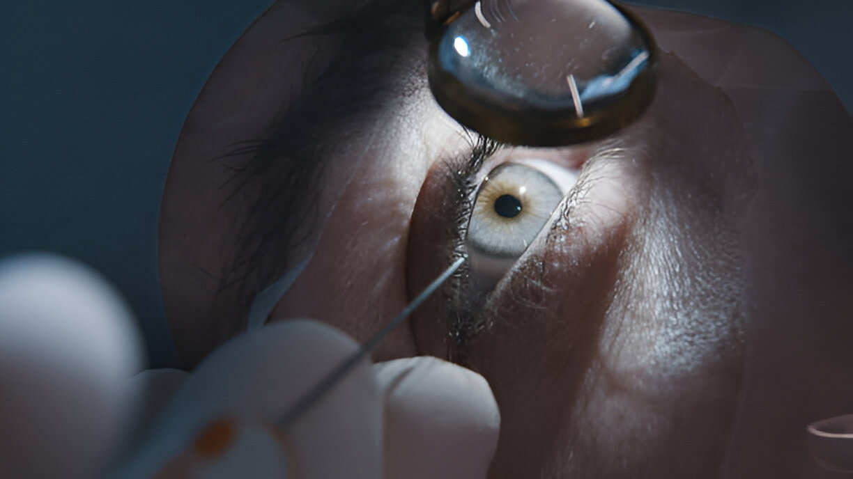What is the Fastest Way to Get Rid of Cataracts?
